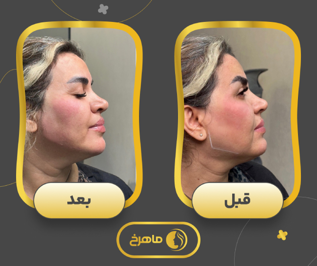 نمونه کار ساکشن غبغب کلینیک زیبایی ماهرخ